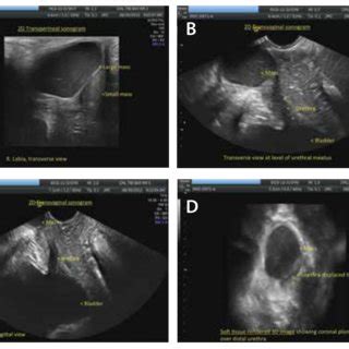 inflammation glande de skene|Skene’s Gland Abscess: Detection With Transperineal。